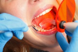 Dental Fillings Fairless Hills PA