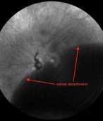 Retinal Detachment treatment in Texas