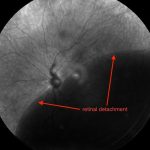 Retinal Detachment Treatment in Texas – Dr. Vijay Khetpal Texas