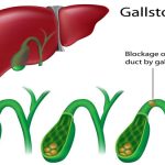 Amazing foods to deal with Gallbladder stones